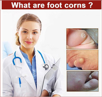 corn plaster corn plaster